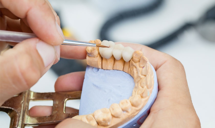 Fractured tooth