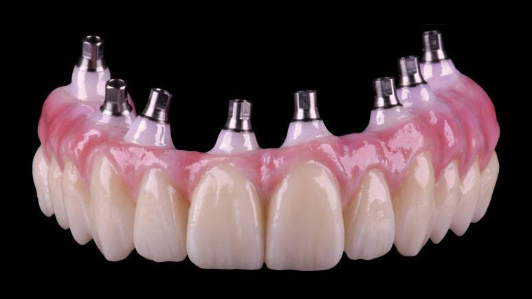 Dental implant teeth